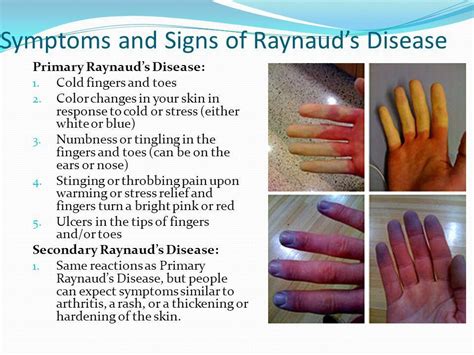 Raynaud’s Syndrome: Symptoms, Causes & Treatment